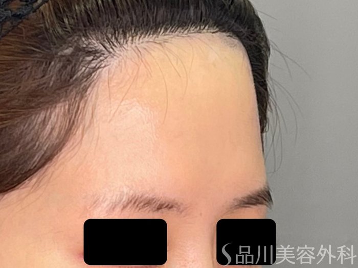 症例NO.71101のBEFORE写真