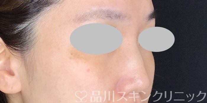 症例NO.67712のBEFORE写真