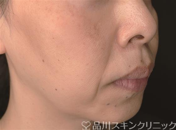 症例NO.58061のBEFORE写真