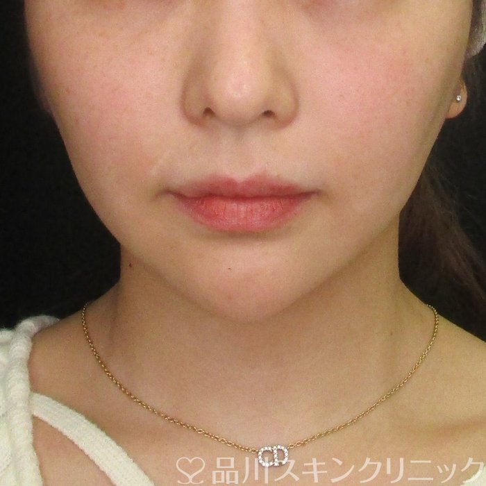 症例NO.70365のBEFORE写真