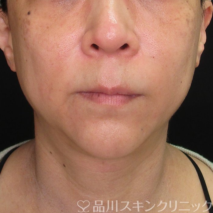 症例NO.70521のAFTER写真