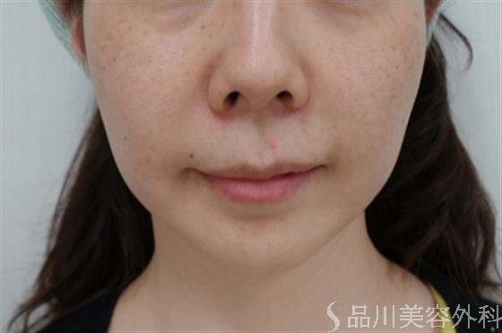 症例NO.33158のBEFORE写真