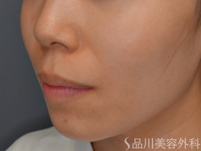 症例NO.73404のBEFORE写真