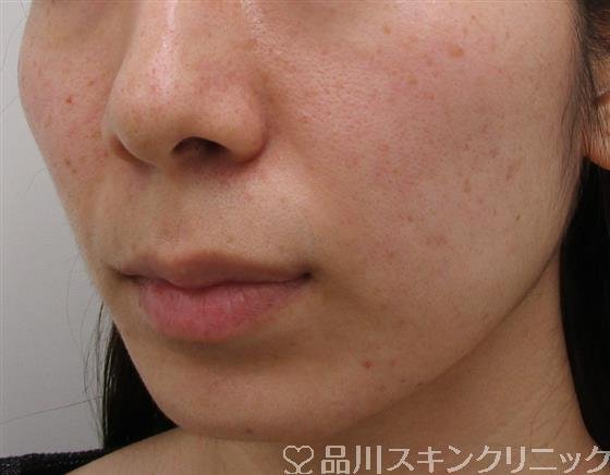 症例NO.36920のBEFORE写真