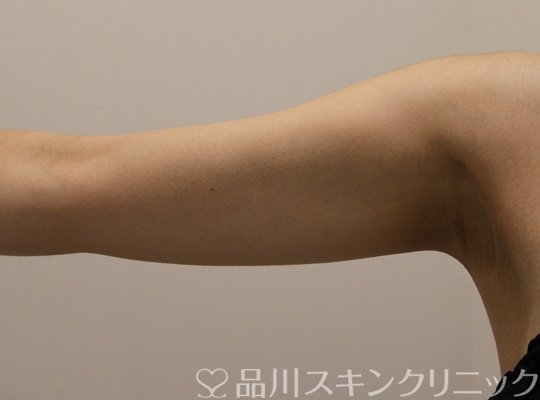 症例NO.75367のBEFORE写真