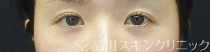 症例NO.65163のBEFORE写真