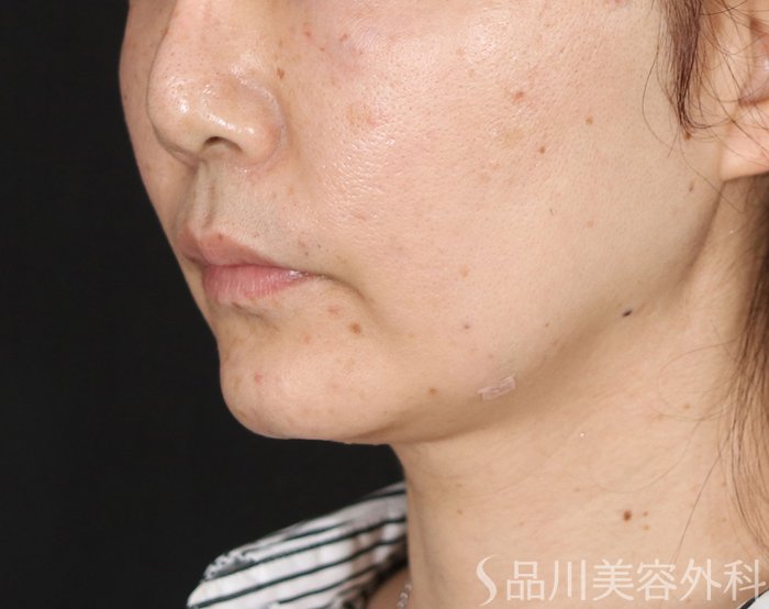 症例NO.71665のAFTER写真