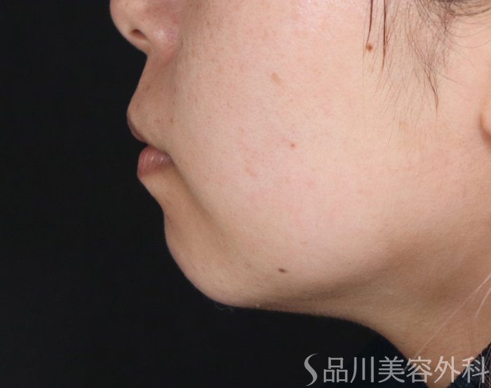 症例NO.73615のBEFORE写真