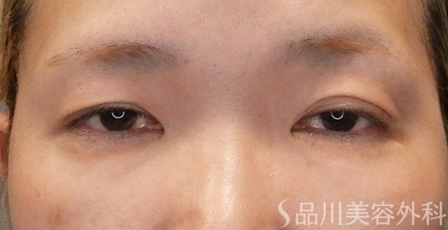 症例NO.74771のBEFORE写真