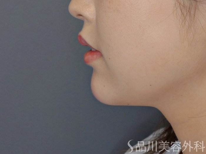 症例NO.71056のAFTER写真