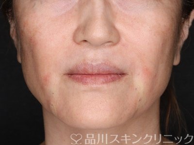症例NO.71628のAFTER写真