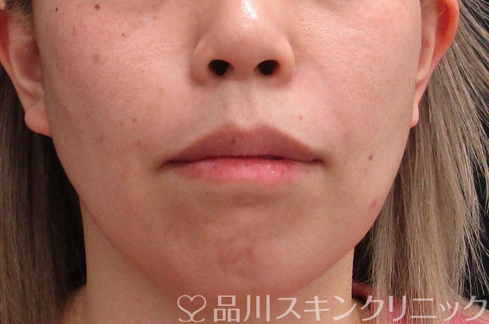 症例NO.70113のAFTER写真