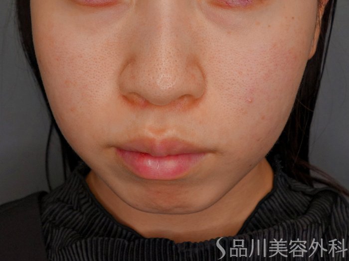 症例NO.73609のBEFORE写真