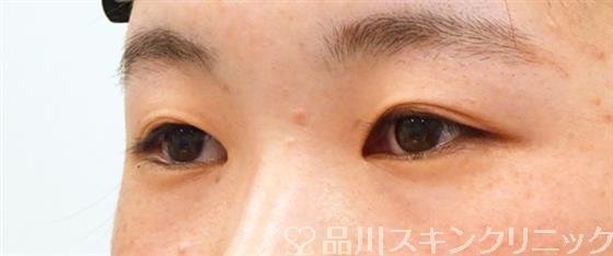 症例NO.52671のBEFORE写真