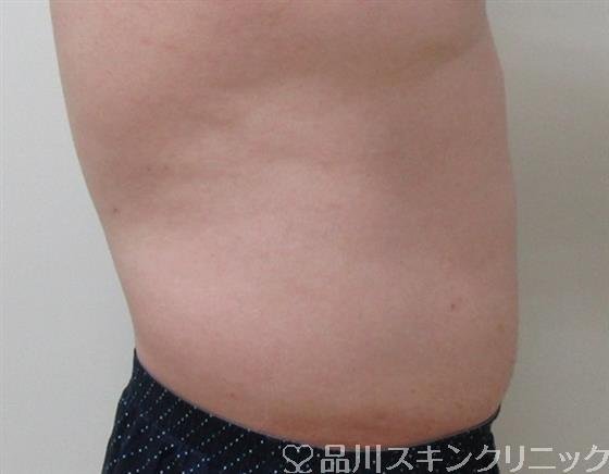 症例NO.32799のAFTER写真