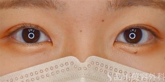 症例NO.59155のAFTER写真