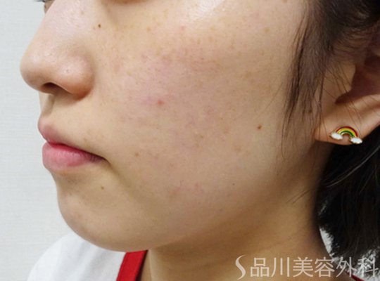 症例NO.74747のBEFORE写真