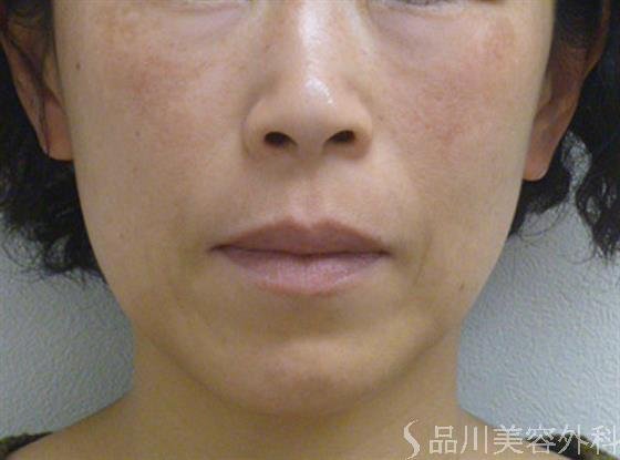症例NO.22528のAFTER写真