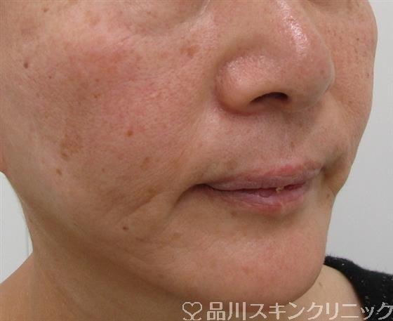 症例NO.41090のBEFORE写真