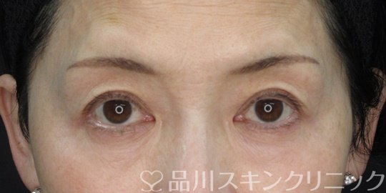 症例NO.72363のBEFORE写真