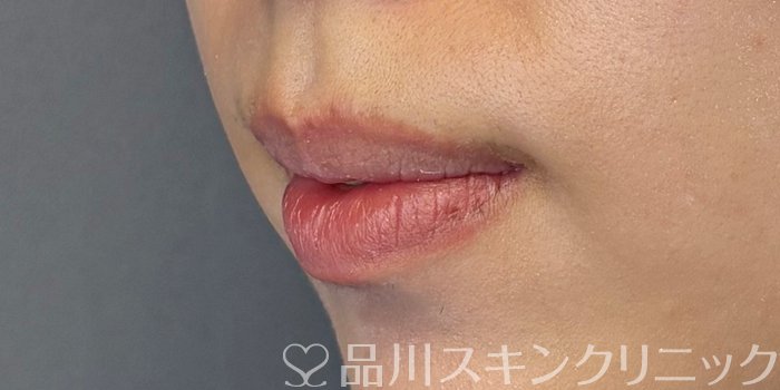 症例NO.71732のBEFORE写真