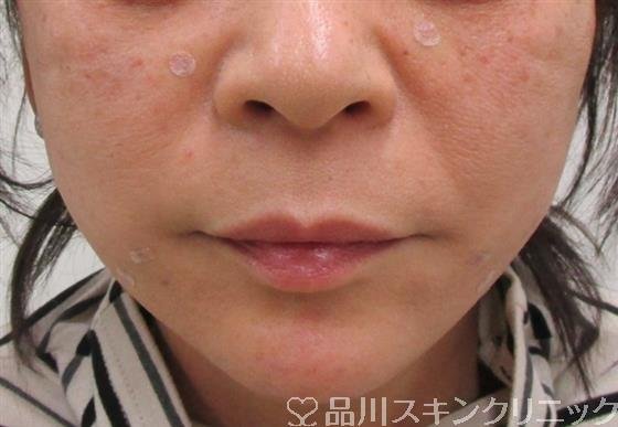 症例NO.34501のAFTER写真