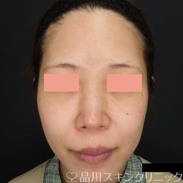 症例NO.75028のBEFORE写真