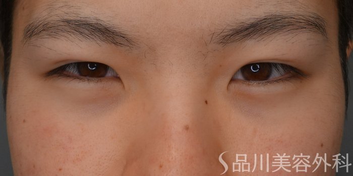 症例NO.74223のBEFORE写真