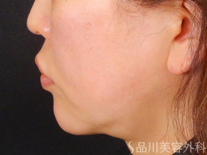 症例NO.67740のBEFORE写真