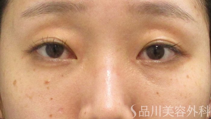 症例NO.72183のAFTER写真