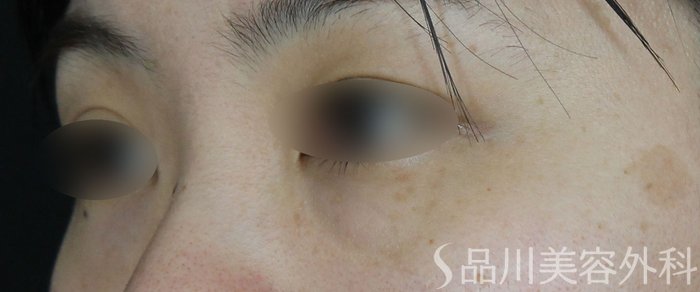 症例NO.65222のBEFORE写真