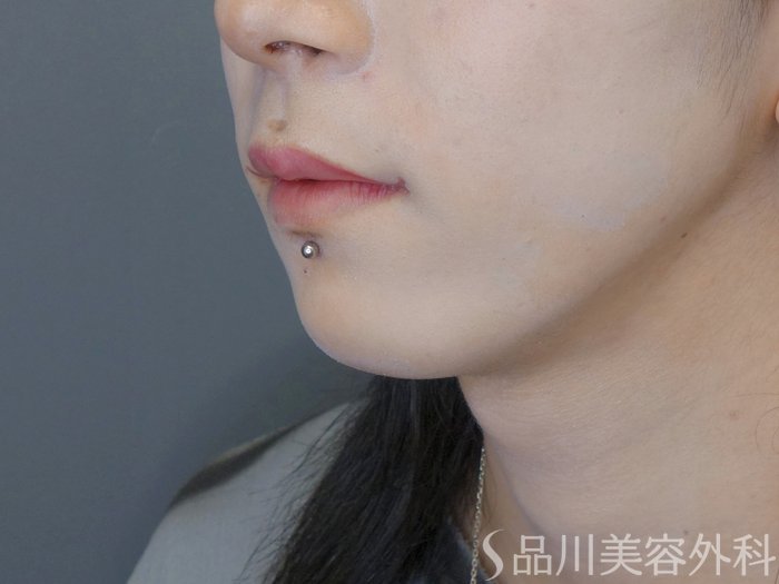 症例NO.70725のBEFORE写真