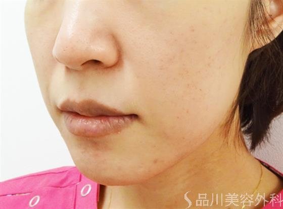 症例NO.32826のBEFORE写真