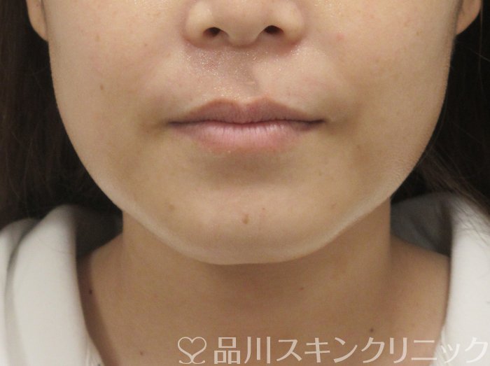 症例NO.73898のBEFORE写真