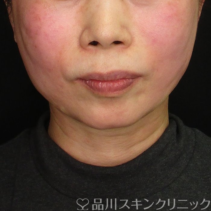 症例NO.69777のAFTER写真