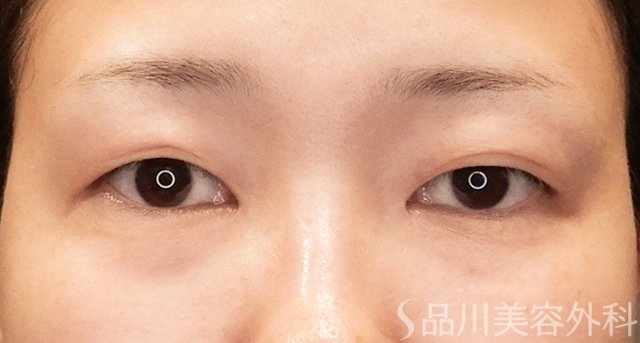 症例NO.75158のBEFORE写真