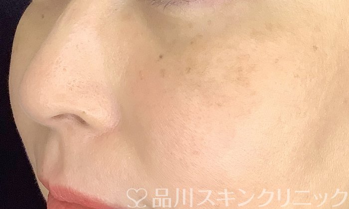 症例NO.71195のAFTER写真