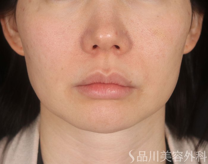 症例NO.73707のBEFORE写真