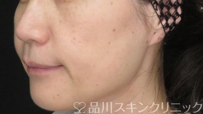 症例NO.70963のBEFORE写真