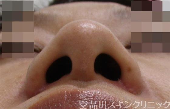 症例NO.38476のAFTER写真