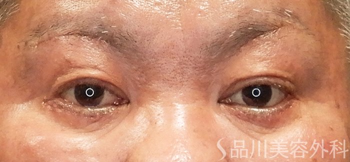 症例NO.69470のAFTER写真