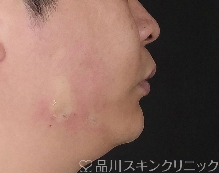 症例NO.70031のAFTER写真