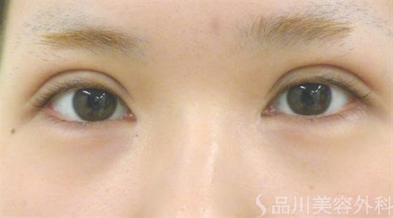 症例NO.40432のAFTER写真