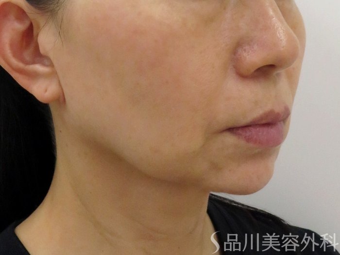 症例NO.73760のBEFORE写真