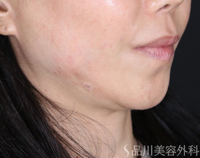 症例NO.72373のAFTER写真