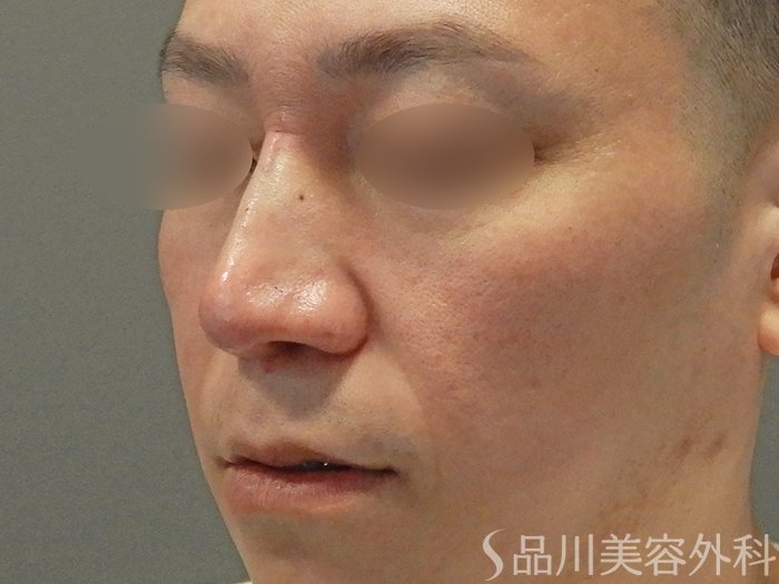 症例NO.70476のAFTER写真