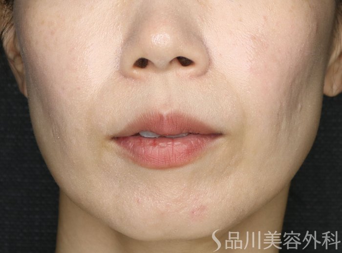 症例NO.73740のBEFORE写真