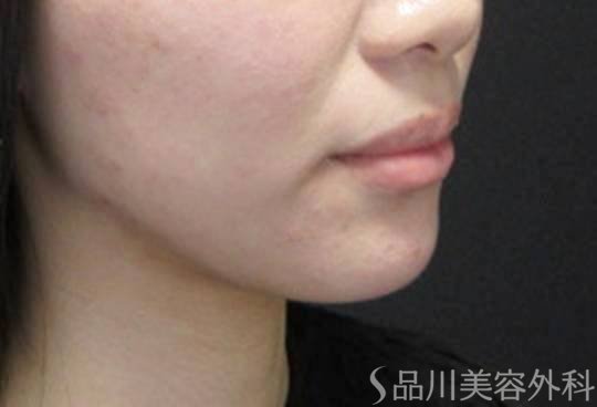 症例NO.74193のBEFORE写真