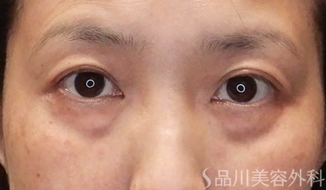 症例NO.75041のBEFORE写真