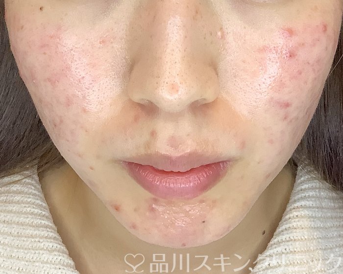 症例NO.70267のBEFORE写真